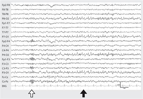bets eeg|steile transienten eeg.